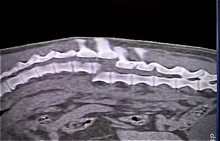 Röntgenufnaheme einer Wirbelsäulenfraktur - Fachbereich neurochirurgie